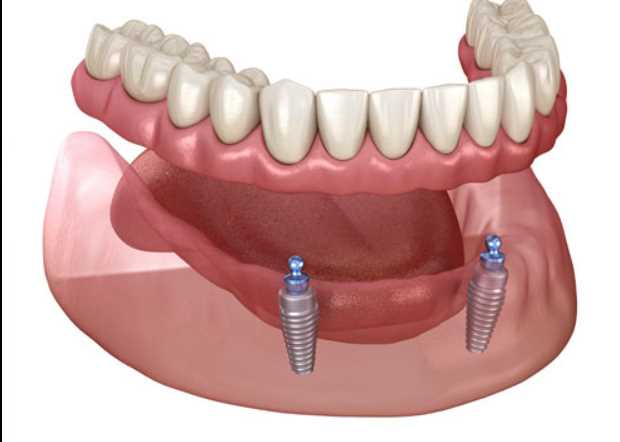 How do implants stabilize your dentures